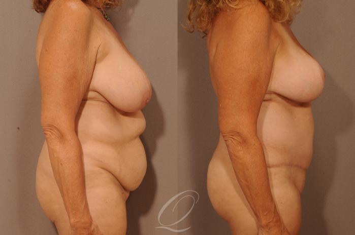 Mommy Makeover Case 1135 Before & After View #3 | Serving Rochester, Syracuse & Buffalo, NY | Quatela Center for Plastic Surgery