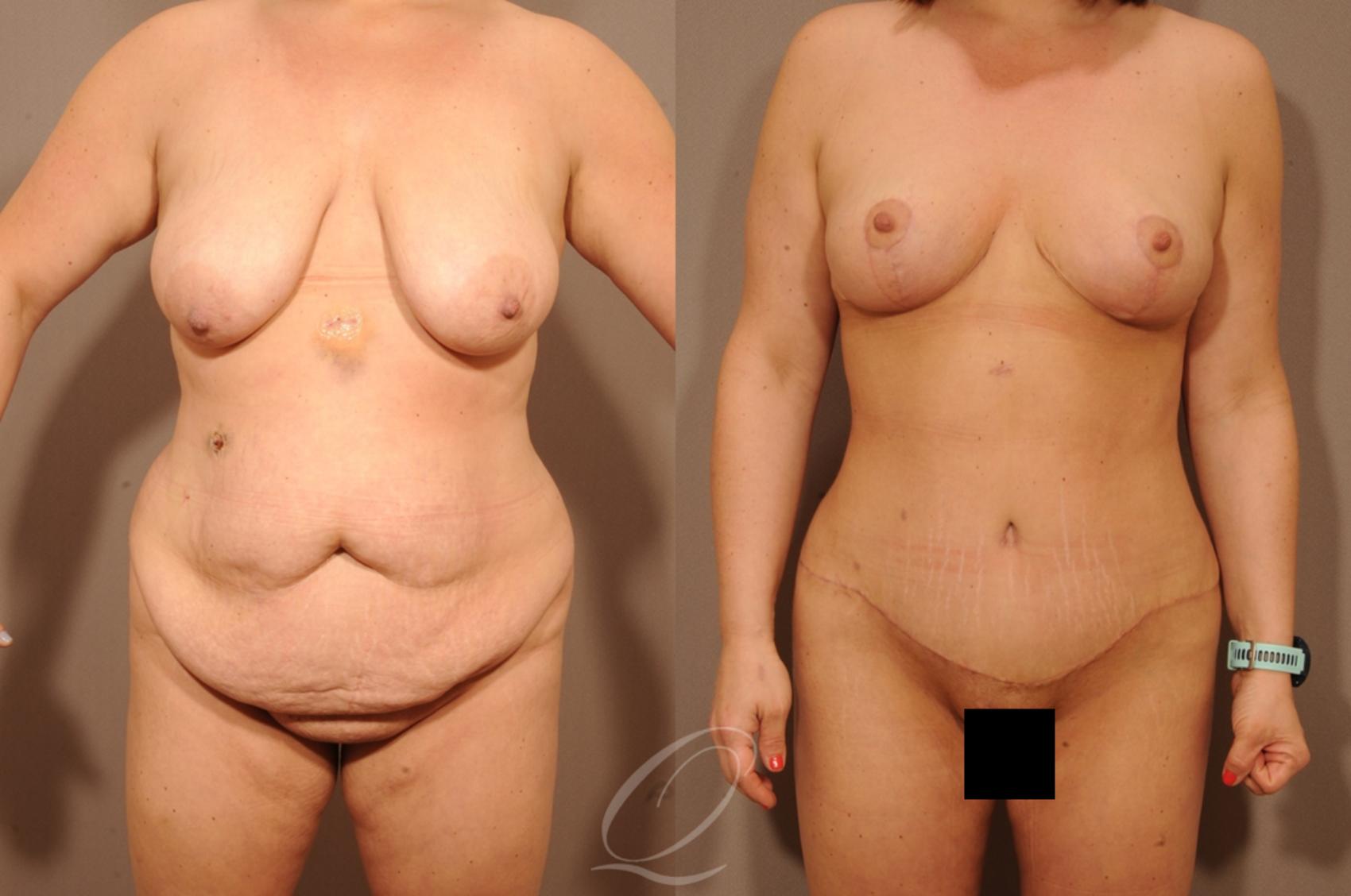 Tummy Tuck Case 1236 Before & After View #1 | Serving Rochester, Syracuse & Buffalo, NY | Quatela Center for Plastic Surgery