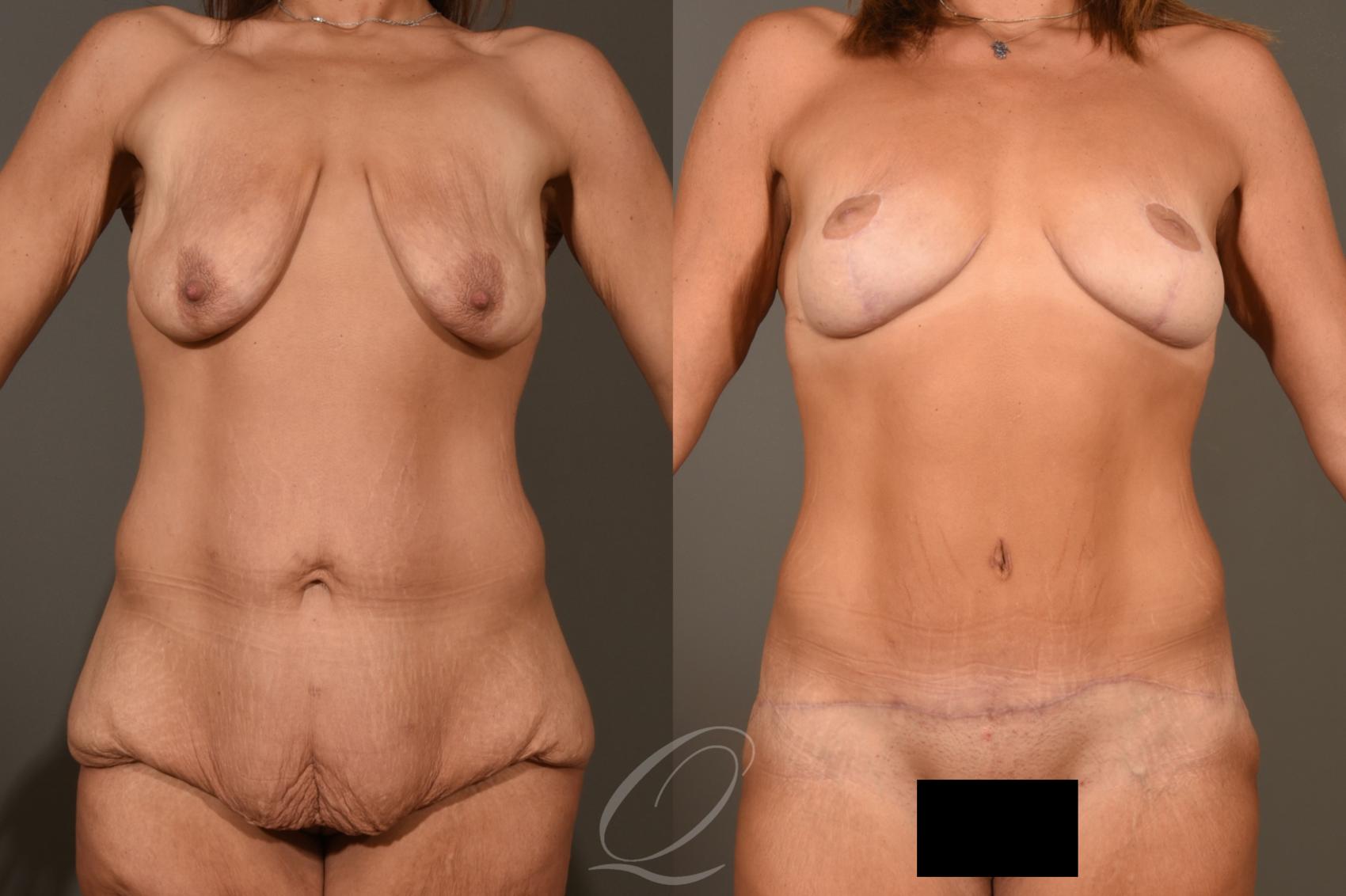 Mommy Makeover Case 1299 Before & After View #1 | Serving Rochester, Syracuse & Buffalo, NY | Quatela Center for Plastic Surgery