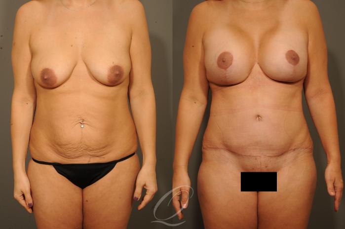 Breast Augmentation with Lift Case 1326 Before & After View #1 | Serving Rochester, Syracuse & Buffalo, NY | Quatela Center for Plastic Surgery