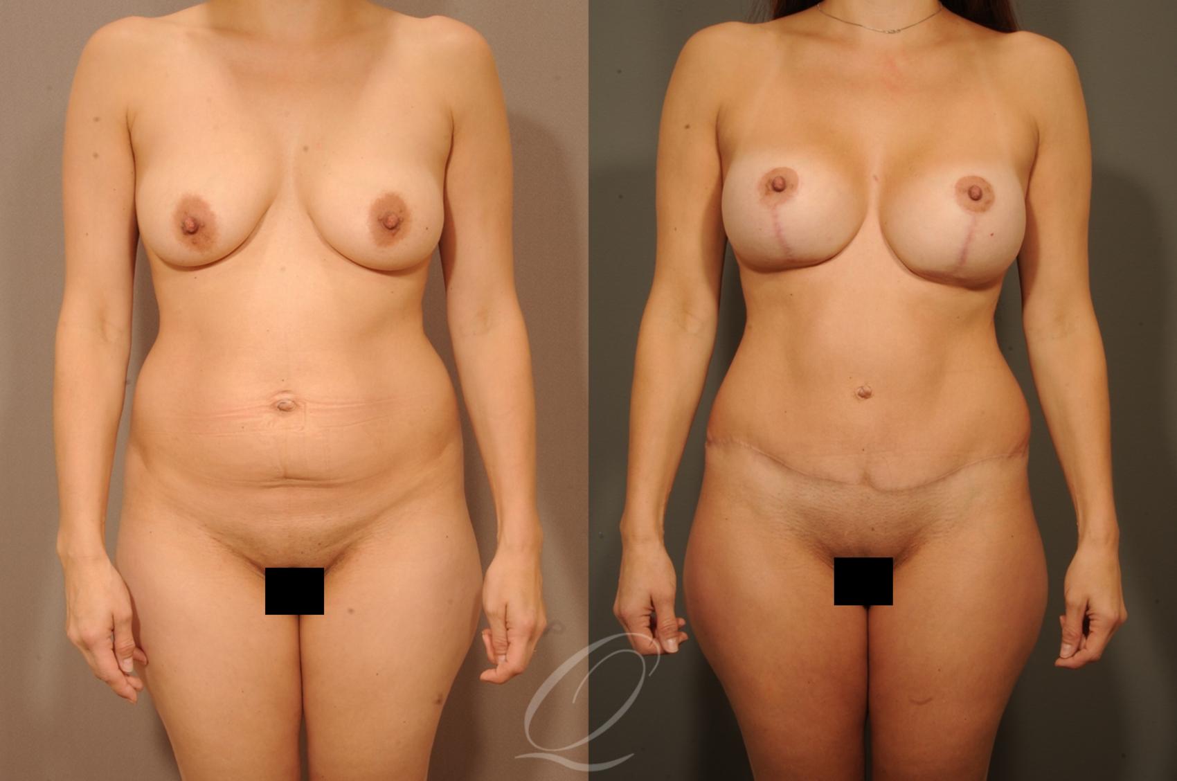 Breast Augmentation with Lift Case 1327 Before & After View #1 | Serving Rochester, Syracuse & Buffalo, NY | Quatela Center for Plastic Surgery