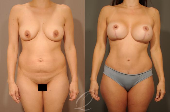 Breast Augmentation with Lift Case 1327 Before & After View #2 | Serving Rochester, Syracuse & Buffalo, NY | Quatela Center for Plastic Surgery