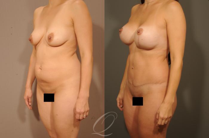 Breast Augmentation with Lift Case 1327 Before & After View #3 | Serving Rochester, Syracuse & Buffalo, NY | Quatela Center for Plastic Surgery