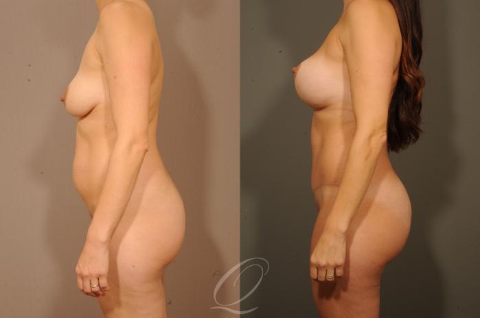 Breast Augmentation with Lift Case 1327 Before & After View #4 | Serving Rochester, Syracuse & Buffalo, NY | Quatela Center for Plastic Surgery