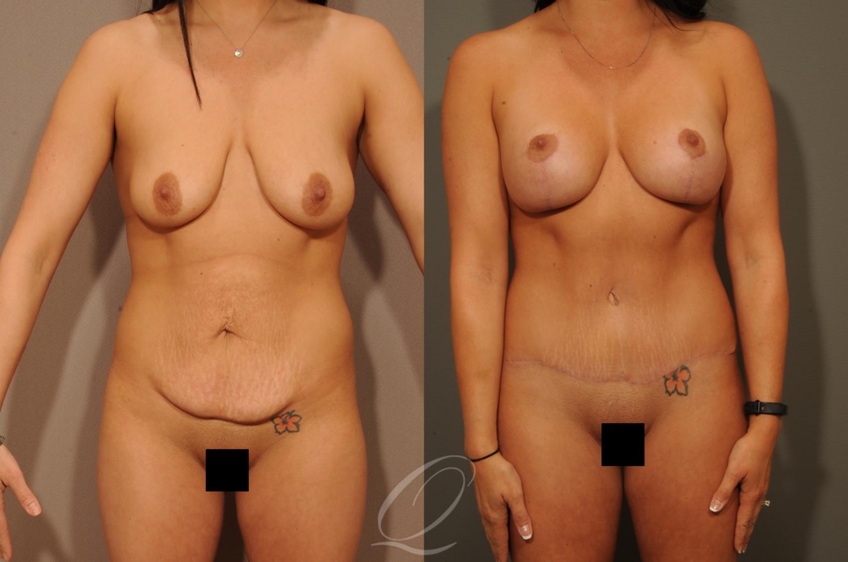 Breast Augmentation with Lift Case 1330 Before & After View #1 | Serving Rochester, Syracuse & Buffalo, NY | Quatela Center for Plastic Surgery