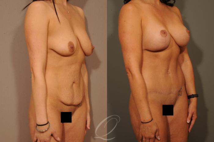 Breast Augmentation with Lift Case 1330 Before & After View #2 | Serving Rochester, Syracuse & Buffalo, NY | Quatela Center for Plastic Surgery
