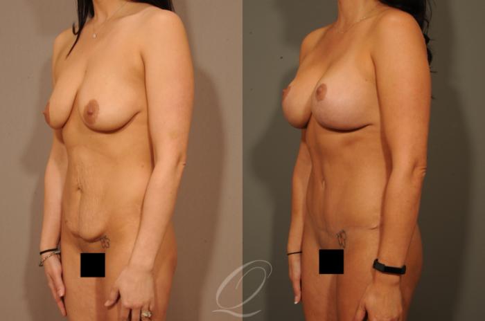 Breast Augmentation with Lift Case 1330 Before & After View #4 | Serving Rochester, Syracuse & Buffalo, NY | Quatela Center for Plastic Surgery