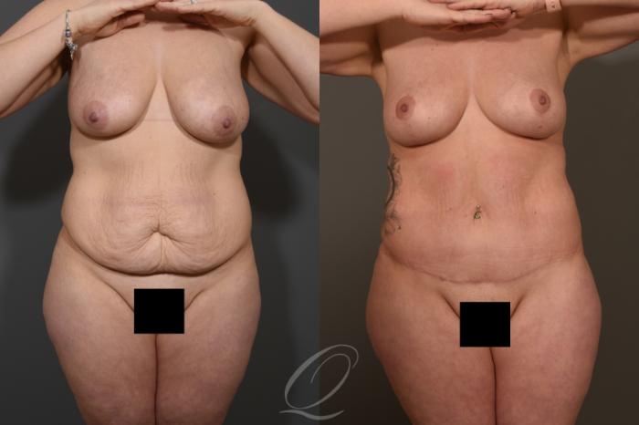 Liposuction Case 1463 Before & After Front | Serving Rochester, Syracuse & Buffalo, NY | Quatela Center for Plastic Surgery