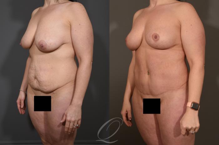 Liposuction Case 1463 Before & After Left Oblique | Serving Rochester, Syracuse & Buffalo, NY | Quatela Center for Plastic Surgery