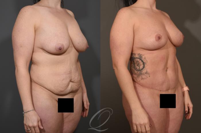 Liposuction Case 1463 Before & After Right Oblique | Serving Rochester, Syracuse & Buffalo, NY | Quatela Center for Plastic Surgery