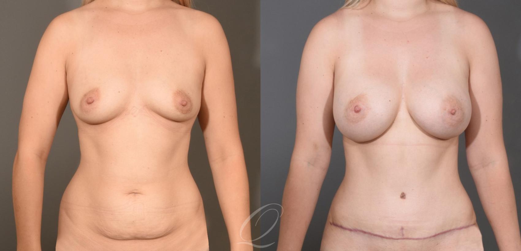 Dual Plane Breast Augmentation Case 1477 Before & After Front | Serving Rochester, Syracuse & Buffalo, NY | Quatela Center for Plastic Surgery