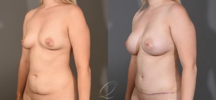 Mommy Makeover Case 1477 Before & After Left Oblique | Serving Rochester, Syracuse & Buffalo, NY | Quatela Center for Plastic Surgery