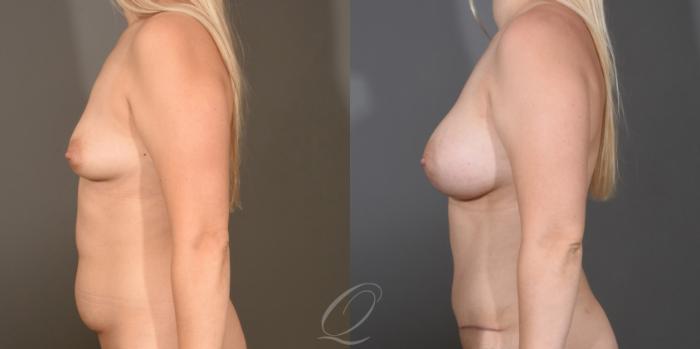 Mommy Makeover Case 1477 Before & After Left Side | Serving Rochester, Syracuse & Buffalo, NY | Quatela Center for Plastic Surgery