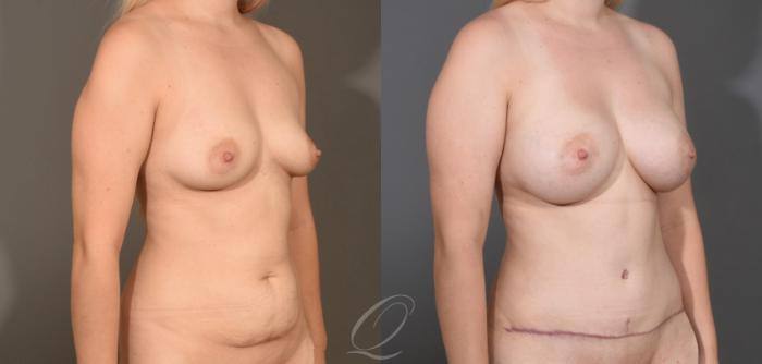 Mommy Makeover Case 1477 Before & After Right Oblique | Serving Rochester, Syracuse & Buffalo, NY | Quatela Center for Plastic Surgery