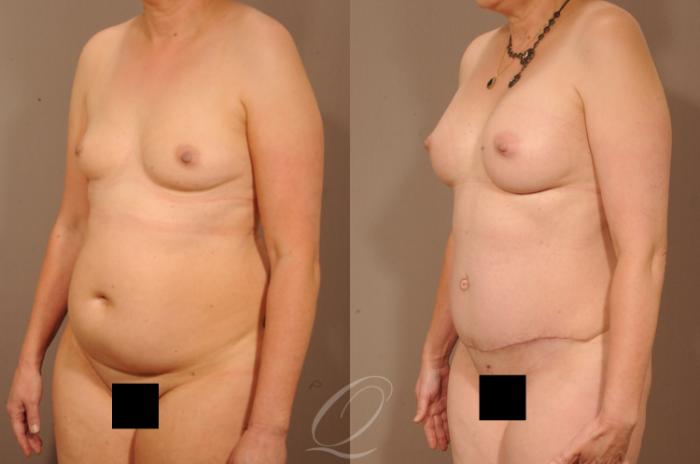 Breast Augmentation with Lift Case 1512 Before & After View #2 | Serving Rochester, Syracuse & Buffalo, NY | Quatela Center for Plastic Surgery