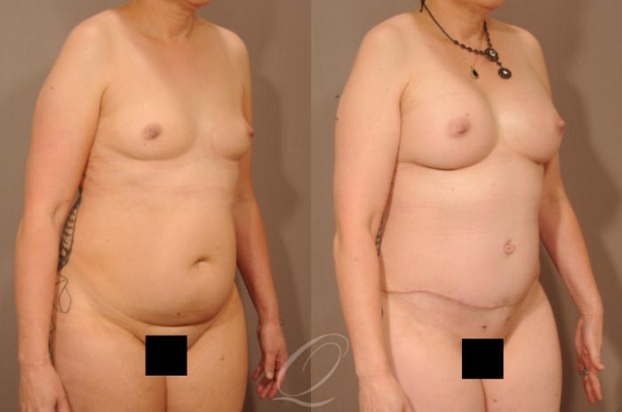 Breast Augmentation with Lift Case 1512 Before & After View #4 | Serving Rochester, Syracuse & Buffalo, NY | Quatela Center for Plastic Surgery