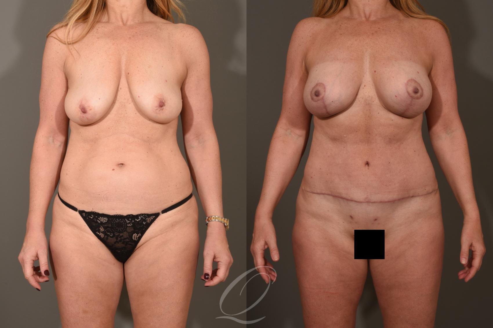 Mommy Makeover Case 1522 Before & After View #1 | Serving Rochester, Syracuse & Buffalo, NY | Quatela Center for Plastic Surgery