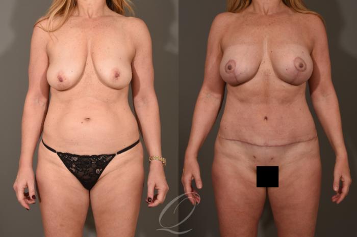 Breast Augmentation with Lift Case 1522 Before & After View #1 | Serving Rochester, Syracuse & Buffalo, NY | Quatela Center for Plastic Surgery