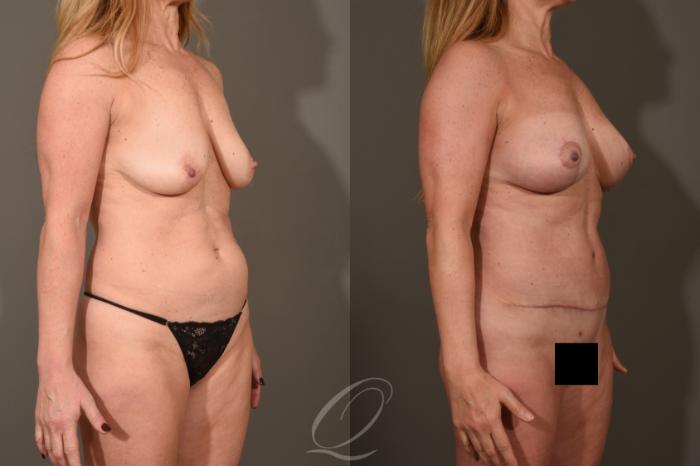 Tummy Tuck Case 1522 Before & After View #2 | Serving Rochester, Syracuse & Buffalo, NY | Quatela Center for Plastic Surgery