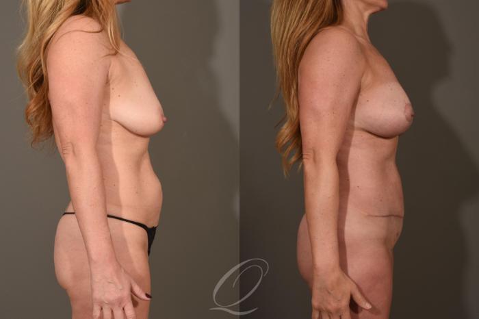 Breast Augmentation with Lift Case 1522 Before & After View #3 | Serving Rochester, Syracuse & Buffalo, NY | Quatela Center for Plastic Surgery