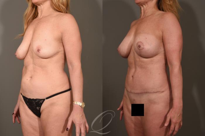 Breast Augmentation with Lift Case 1522 Before & After View #4 | Serving Rochester, Syracuse & Buffalo, NY | Quatela Center for Plastic Surgery
