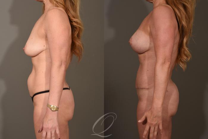 Breast Augmentation with Lift Case 1522 Before & After View #5 | Serving Rochester, Syracuse & Buffalo, NY | Quatela Center for Plastic Surgery