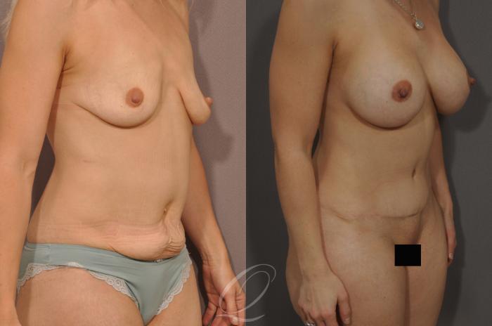 Mommy Makeover Case 161 Before & After View #2 | Serving Rochester, Syracuse & Buffalo, NY | Quatela Center for Plastic Surgery