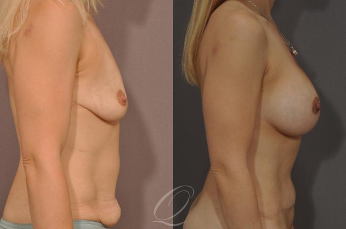 Mommy Makeover Case 161 Before & After View #3 | Serving Rochester, Syracuse & Buffalo, NY | Quatela Center for Plastic Surgery