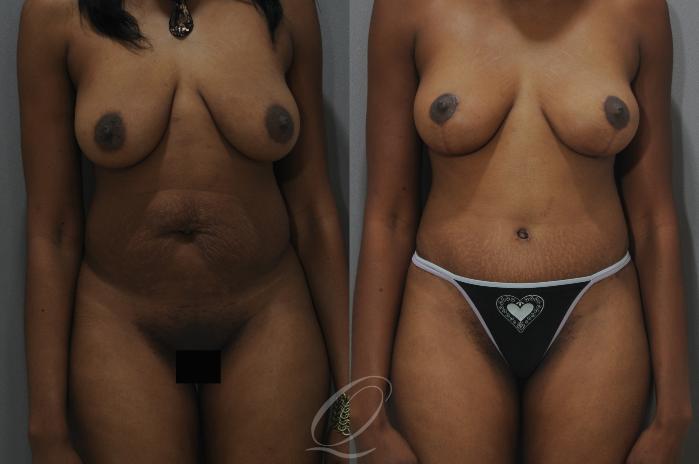 Breast Lift Case 162 Before & After View #1 | Serving Rochester, Syracuse & Buffalo, NY | Quatela Center for Plastic Surgery