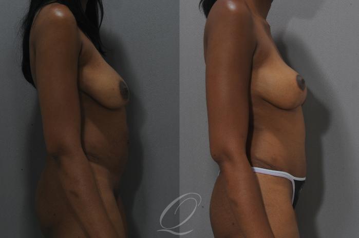 Breast Lift Case 162 Before & After View #3 | Serving Rochester, Syracuse & Buffalo, NY | Quatela Center for Plastic Surgery