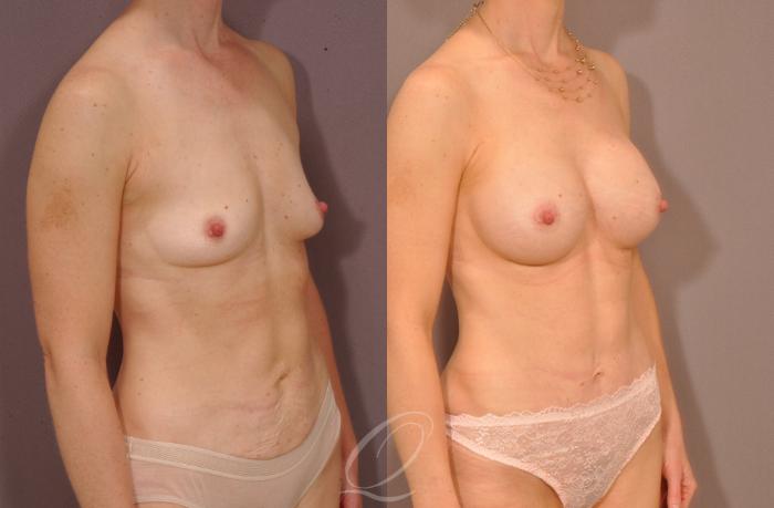 Mommy Makeover Case 166 Before & After View #2 | Serving Rochester, Syracuse & Buffalo, NY | Quatela Center for Plastic Surgery