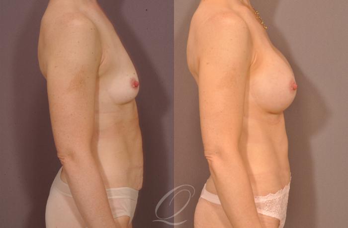 Mommy Makeover Case 166 Before & After View #3 | Serving Rochester, Syracuse & Buffalo, NY | Quatela Center for Plastic Surgery