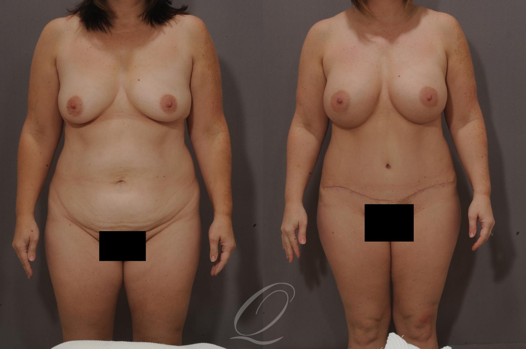Mommy Makeover Case 169 Before & After View #1 | Serving Rochester, Syracuse & Buffalo, NY | Quatela Center for Plastic Surgery