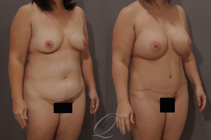 Mommy Makeover Case 169 Before & After View #2 | Serving Rochester, Syracuse & Buffalo, NY | Quatela Center for Plastic Surgery