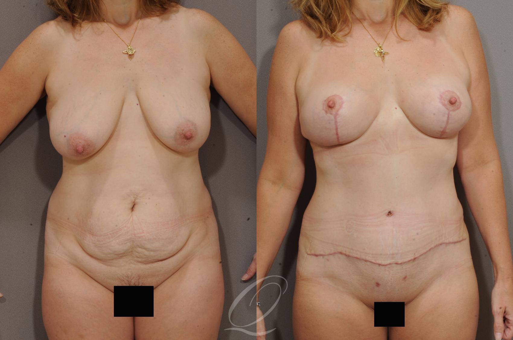 Mommy Makeover Case 172 Before & After View #1 | Serving Rochester, Syracuse & Buffalo, NY | Quatela Center for Plastic Surgery