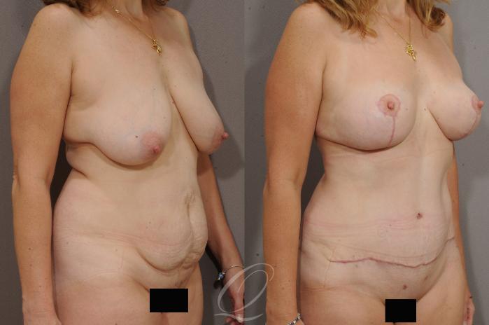 Breast Lift Case 172 Before & After View #2 | Serving Rochester, Syracuse & Buffalo, NY | Quatela Center for Plastic Surgery