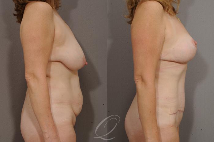 Breast Lift Case 172 Before & After View #3 | Serving Rochester, Syracuse & Buffalo, NY | Quatela Center for Plastic Surgery