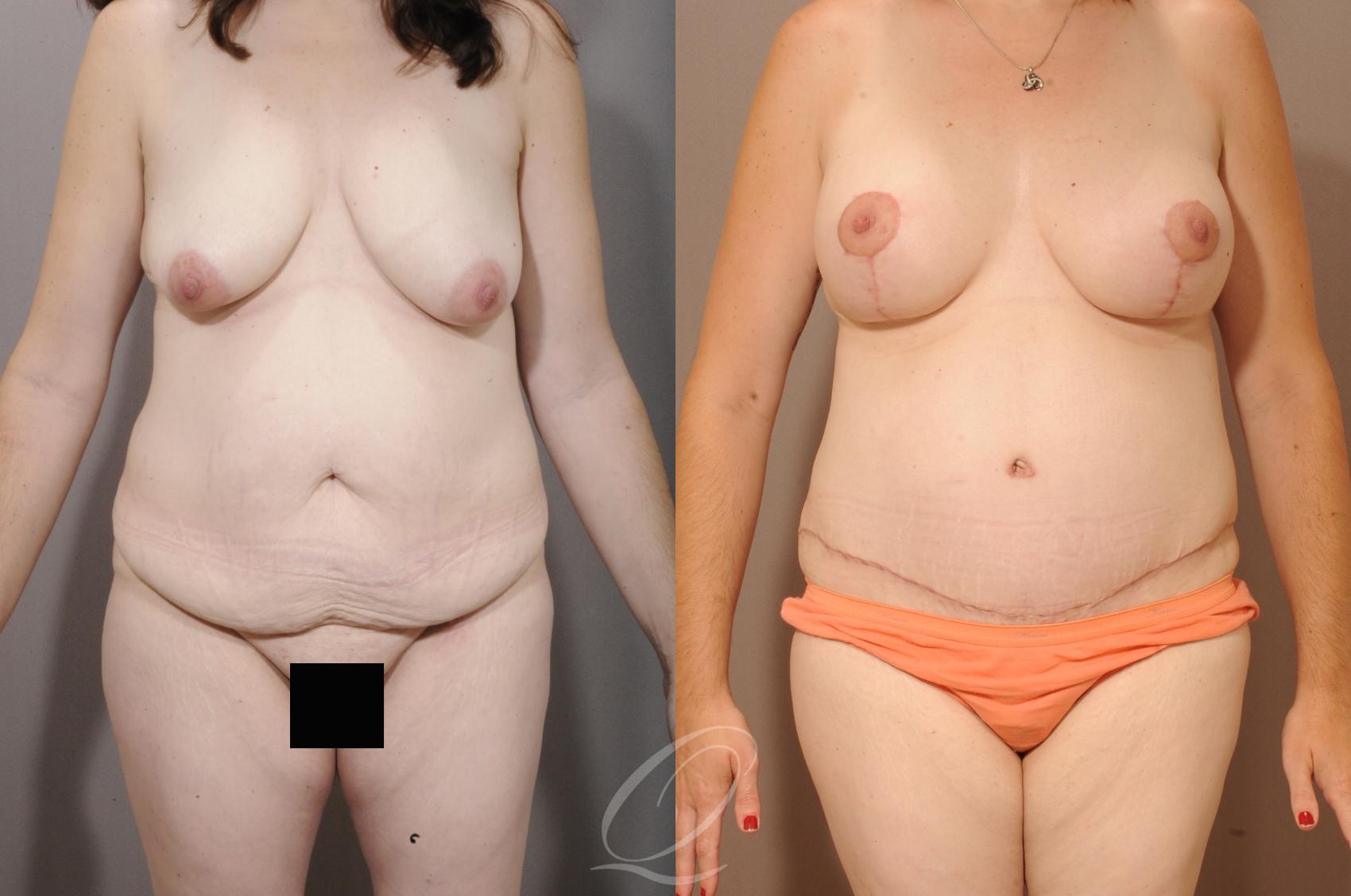 Mommy Makeover Case 173 Before & After View #1 | Serving Rochester, Syracuse & Buffalo, NY | Quatela Center for Plastic Surgery