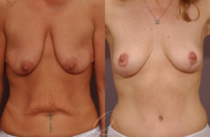 Breast Lift Case 220 Before & After View #1 | Serving Rochester, Syracuse & Buffalo, NY | Quatela Center for Plastic Surgery