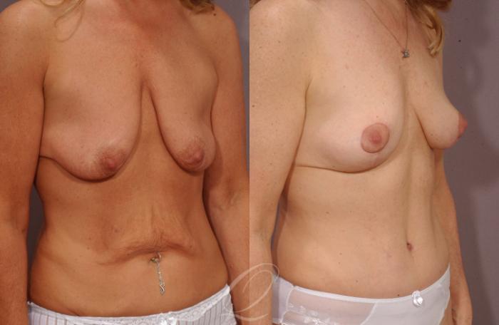 Mommy Makeover Case 220 Before & After View #2 | Serving Rochester, Syracuse & Buffalo, NY | Quatela Center for Plastic Surgery