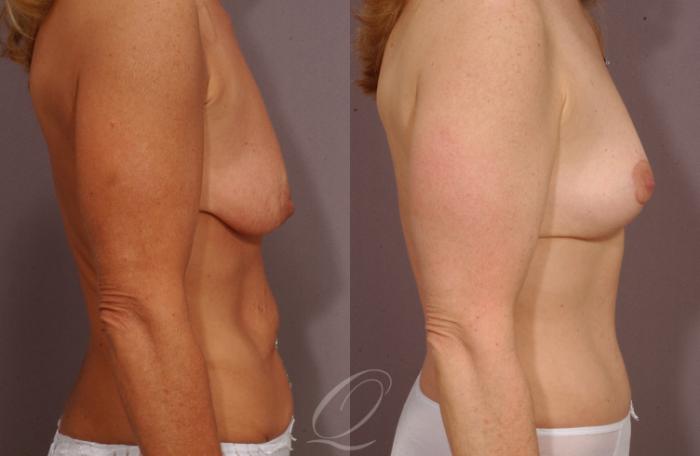 Mommy Makeover Case 220 Before & After View #3 | Serving Rochester, Syracuse & Buffalo, NY | Quatela Center for Plastic Surgery