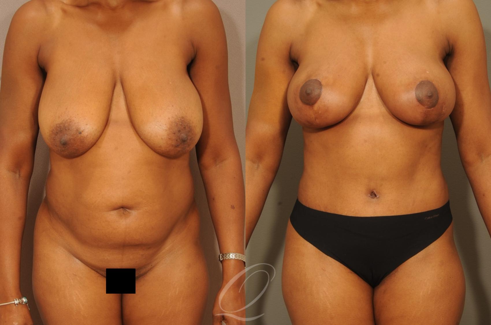 Mommy Makeover Case 312 Before & After View #1 | Serving Rochester, Syracuse & Buffalo, NY | Quatela Center for Plastic Surgery