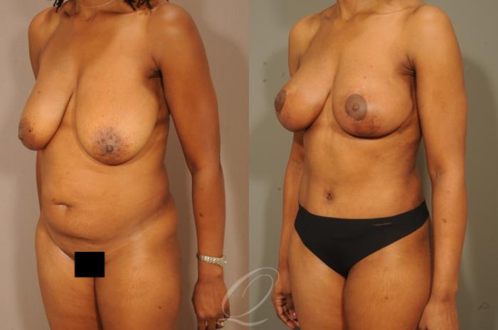 Mommy Makeover Case 312 Before & After View #2 | Serving Rochester, Syracuse & Buffalo, NY | Quatela Center for Plastic Surgery
