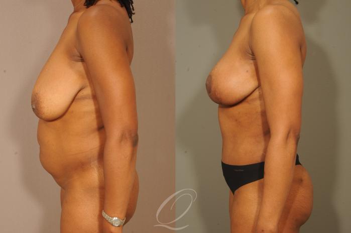 Mommy Makeover Case 312 Before & After View #3 | Serving Rochester, Syracuse & Buffalo, NY | Quatela Center for Plastic Surgery