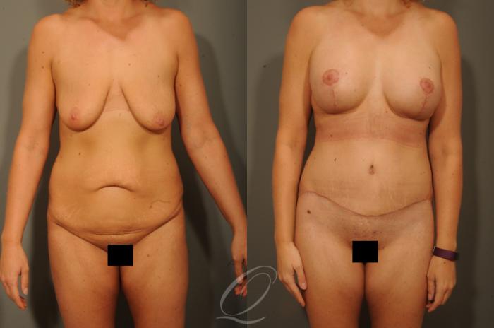 Breast Augmentation with Lift Case 314 Before & After View #1 | Serving Rochester, Syracuse & Buffalo, NY | Quatela Center for Plastic Surgery