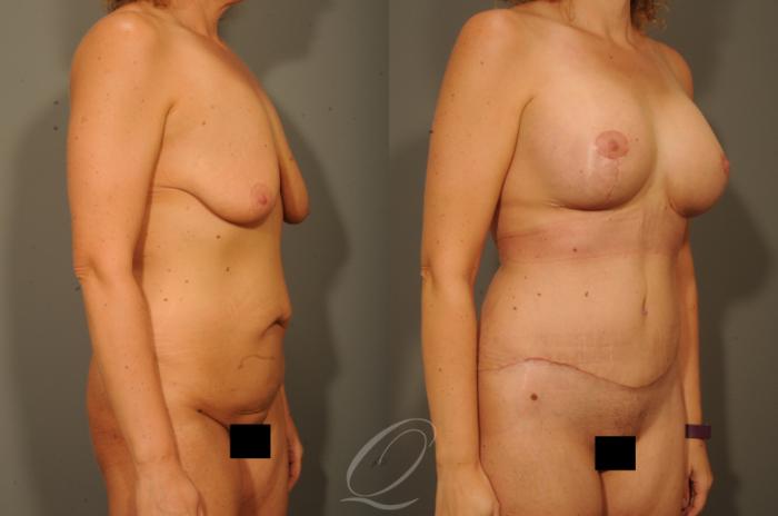 Breast Augmentation with Lift Case 314 Before & After View #2 | Serving Rochester, Syracuse & Buffalo, NY | Quatela Center for Plastic Surgery