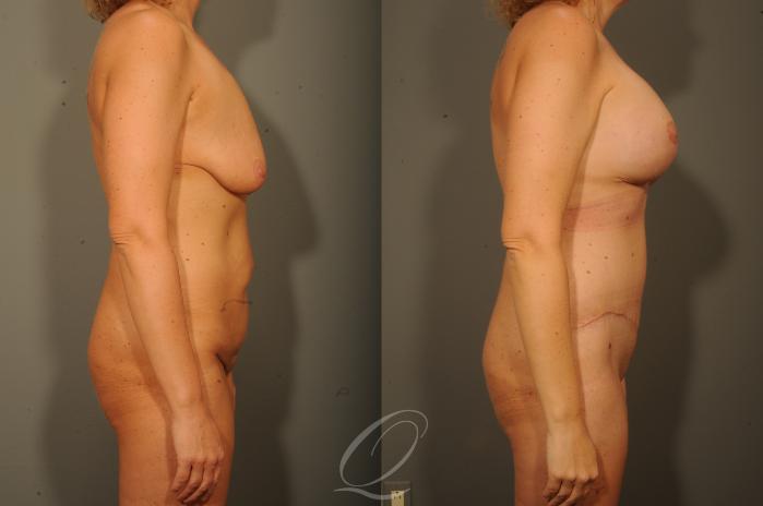 Breast Augmentation with Lift Case 314 Before & After View #3 | Serving Rochester, Syracuse & Buffalo, NY | Quatela Center for Plastic Surgery
