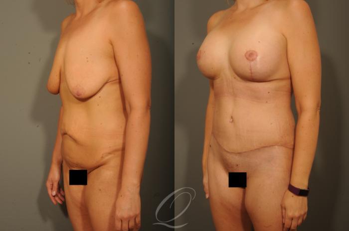 Breast Augmentation with Lift Case 314 Before & After View #4 | Serving Rochester, Syracuse & Buffalo, NY | Quatela Center for Plastic Surgery
