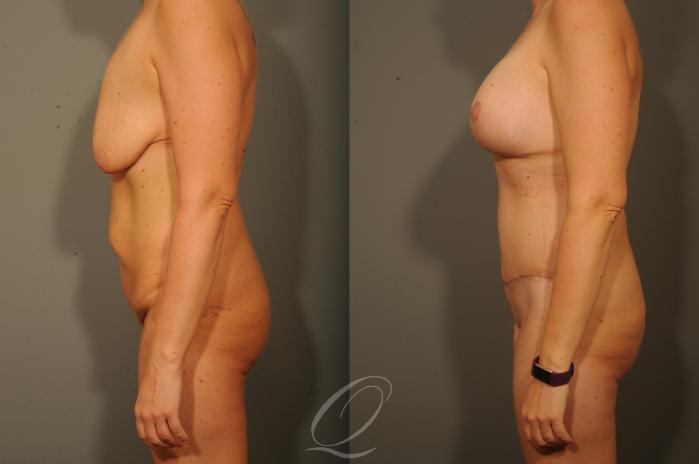 Breast Augmentation with Lift Case 314 Before & After View #5 | Serving Rochester, Syracuse & Buffalo, NY | Quatela Center for Plastic Surgery