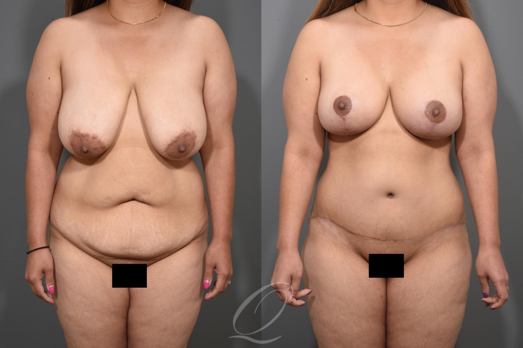 Breast Lift Case 346 Before & After View #1 | Serving Rochester, Syracuse & Buffalo, NY | Quatela Center for Plastic Surgery